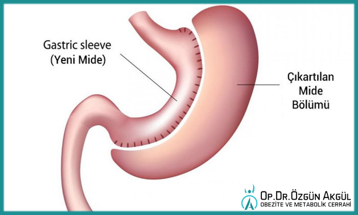 Tüp Mide Ameliyatı